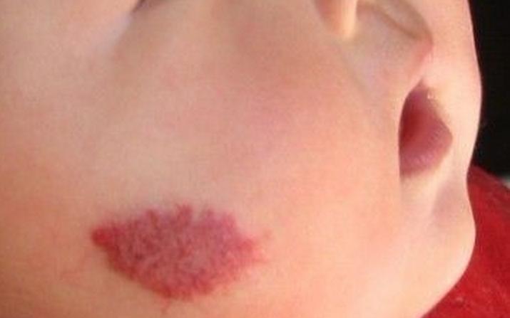 婴儿身上有痣和胎记,婴儿胎记和痣怎么区分