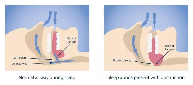 防止磨牙的牙套到底有没有用,磨牙严重牙套推荐
