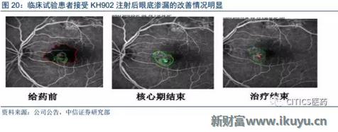 中国眼科治疗近视眼最新突破,国内眼科青光眼