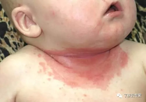 儿童皮肤病防治知识大全,儿童皮肤科护理流程