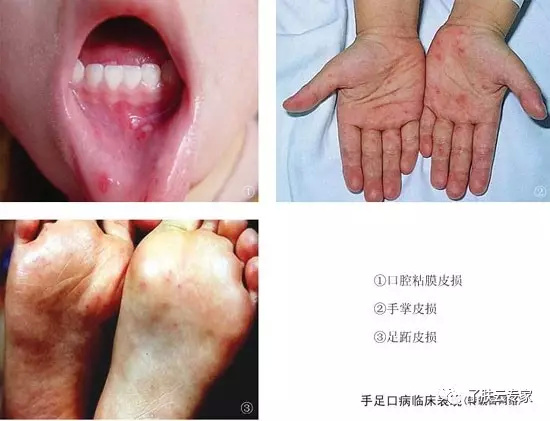 儿童皮肤病防治知识大全,儿童皮肤科护理流程