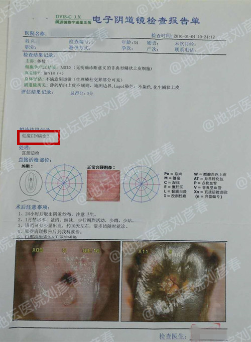 病例分享——宫颈CIN1级的治疗