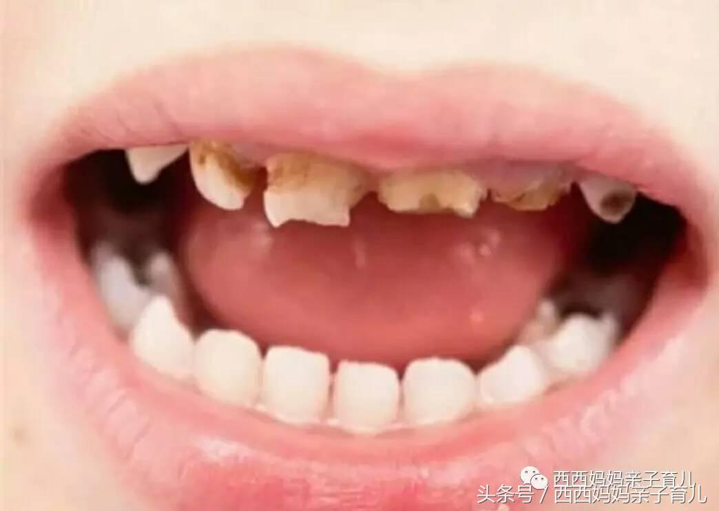 孩子的乳牙越来越小怎么办,怎么有些孩子特别容易蛀牙