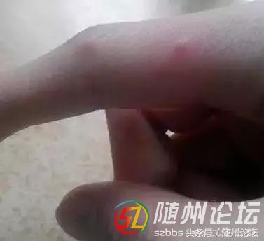 水痘传染病防控知识宣传图片,水痘传染病防控知识宣讲