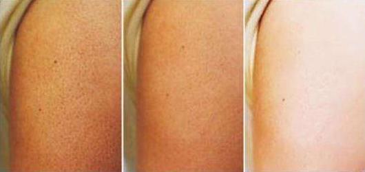 肥胖纹是不能消除的，只能淡化，跟着这5个方法在家也能改善