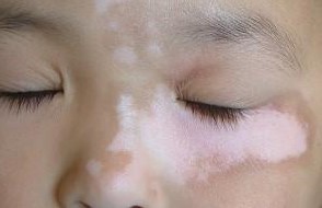 华夏讲述:白斑反复有原因?早早防范不复发?