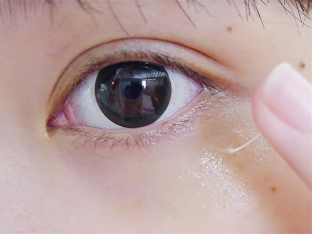 眼里面长了一个白色颗粒,眼周围白色小颗粒怎么去除