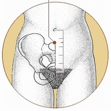 胁痛针灸,胁肋疼痛董氏针灸取穴处方