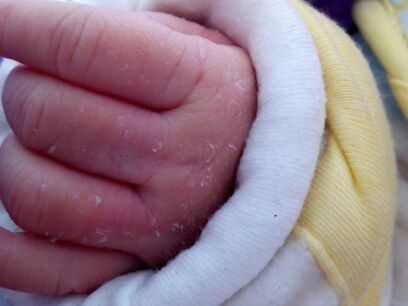 新生儿身上脱皮还会长痘吗,新生儿10天身上脱皮