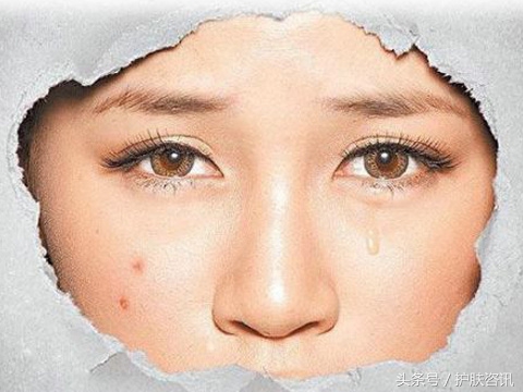 成年人脸上长痘痘什么原因,成年人长痘痘是缺乏营养吗