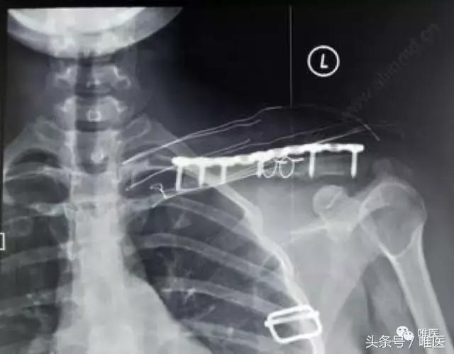 手腕粉碎性骨折钢钉固定,锁骨粉碎性骨折钢丝没取