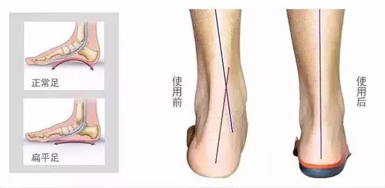 足弓和脚后跟痛怎么回事,长期走路脚掌痛鞋垫软还是硬