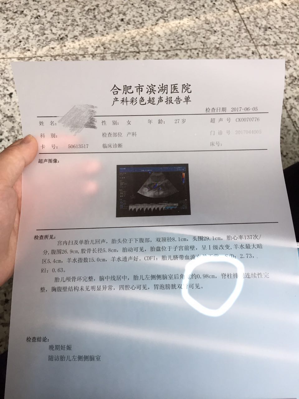 左侧脑室吸收了又宽了,新生儿左侧脑室囊肿多久能吸收