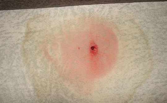 肾炎治愈后好复发这样做能防治