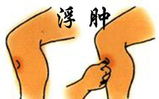 肾炎治愈后好复发这样做能防治