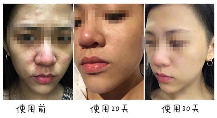 激素脸戒断期如何护理,激素脸治疗期间吃什么有助恢复