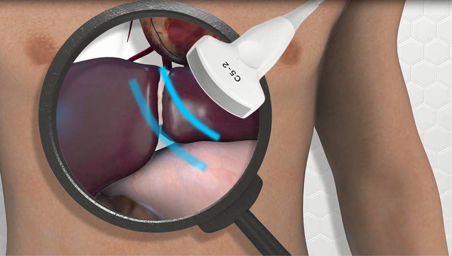 囊肿硬化治疗无效,囊肿硬化能自愈吗