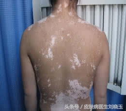 白癜风早期可以吃白癜风胶囊吗,白癜风怎么才能知道已经治好了