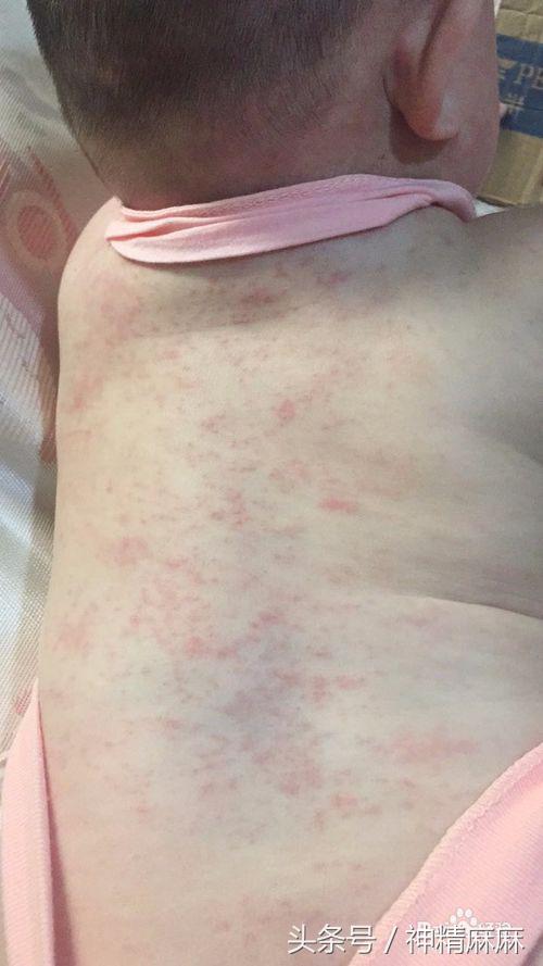痱子湿疹荨麻疹怎么区分,湿疹麻疹痱子
