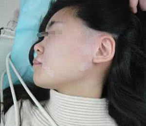 爱美的女人却得了白癜风,女子爱美变白得了白癜风