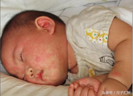 身上都是小红点怎么回事没症状,全身突然起小红点是什么症状