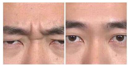 改善川字纹让你年轻,川字纹最好的解决办法