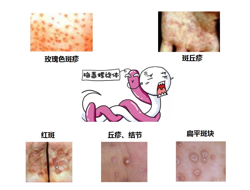 不瘙痒的皮肤病,小心是梅毒哦!