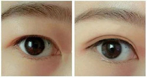 800的双眼皮和8000的双眼皮区别,五毛块钱的双眼皮