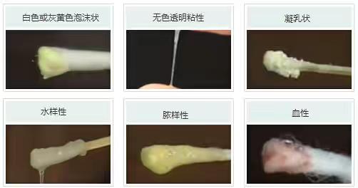 白带常规检查前注意事项,白带出现这三种情况要警惕