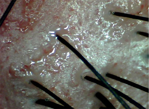 头皮毛囊炎用什么洗头好,头皮毛囊炎反复用什么洗头