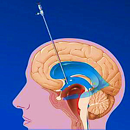蛛网膜囊肿什么情况下要开颅手术,枕大池蛛网膜囊肿有几种手术方法