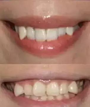 霓虹人民牙齿烂,居然引起了国际讨论背后原因才是父母该重视的