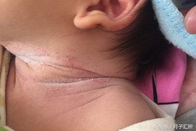 身上都是小红点怎么回事没症状,全身突然起小红点是什么症状