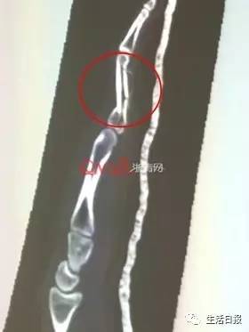 摔了一跤把手指摔骨折了,摔了一跤把手指头摔骨折