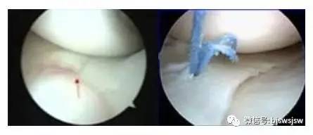 健身半月板疼怎么回事,健身房爬坡会造成半月板损伤吗