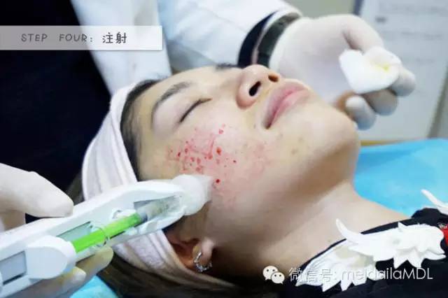 无针水光首次体验价69元,1元体验水光针