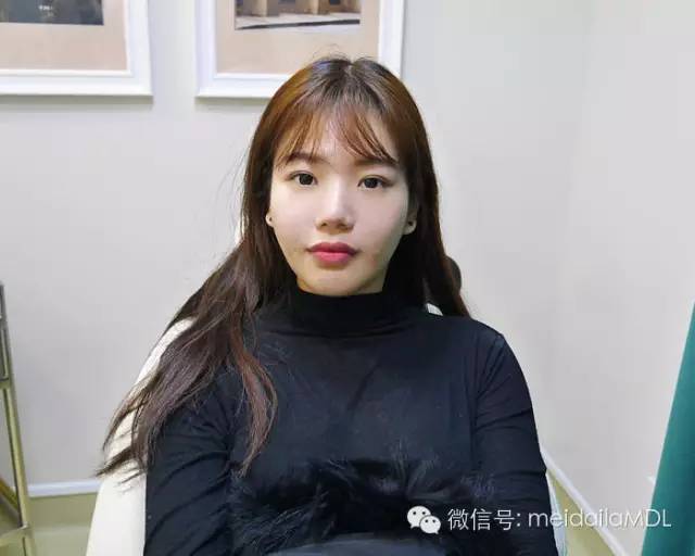 填充法令纹用什么牌子玻尿酸最好,法令纹填充胶原蛋白还是玻尿酸好