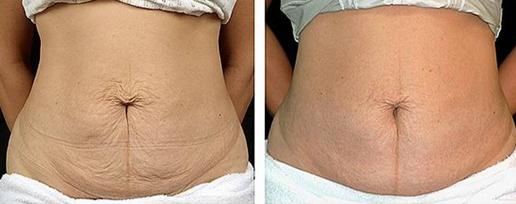 产后皮肤松垮怎么变紧致,产后脸部松弛下垂怎么办