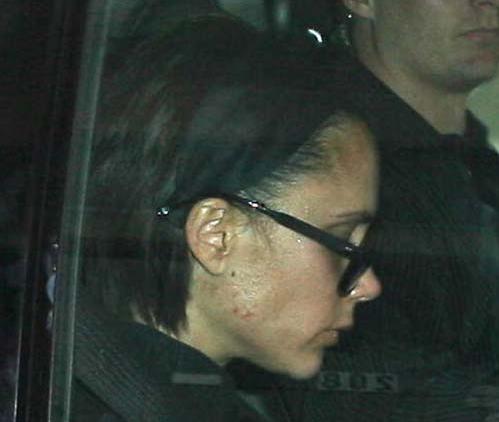 皮肤科医生专家治痤疮,皮肤科医生怎么预防痘坑