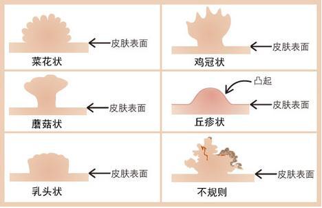 肛门长了一片肉疙瘩，她跟医生这么说