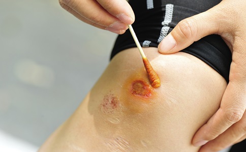 常见的出血急救有几种方法,骨折出血人员应急急救步骤