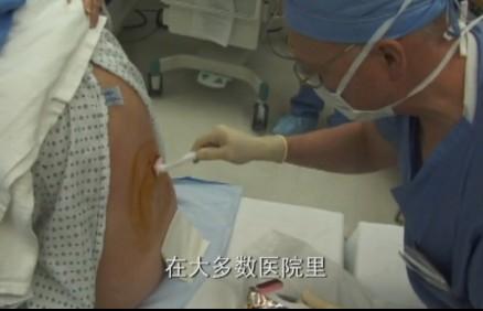 孕妇剖腹生下双胞胎惊呆医生,双胞胎出生过程实录