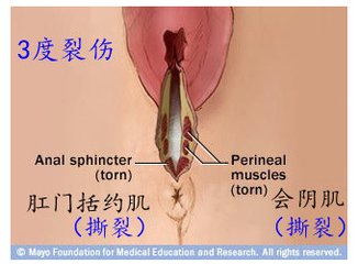 第67课:会阴侧切与撕裂
