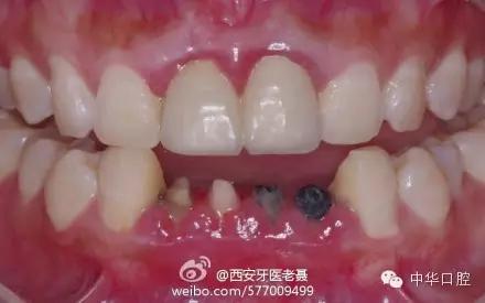 刘涛明星换牙是真是假,刘涛是全种植牙还是换牙