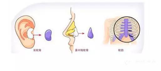 鼻子垫的太往上了,鼻子垫得不高是不是不容易歪