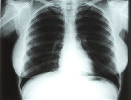 葡萄胎怎么检查出来呢,葡萄胎再次怀孕要不要检查卵子