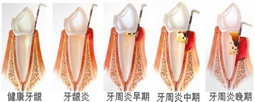 老年人牙龈肿了怎么快速消除,老人牙龈肿痛脸肿是怎么回事