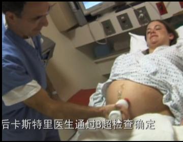 孕妇剖腹生下双胞胎惊呆医生,双胞胎出生过程实录