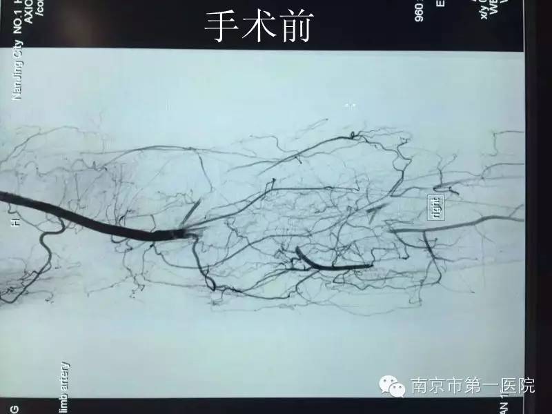 腿中风能治好吗,腿中风后遗症怎么样的