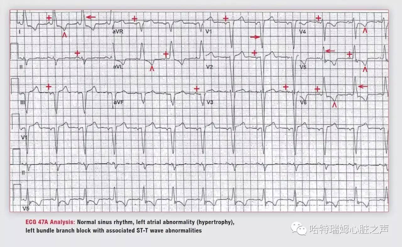 左束支阻滞会引起心梗吗,急性前间壁心肌梗死怎么治疗